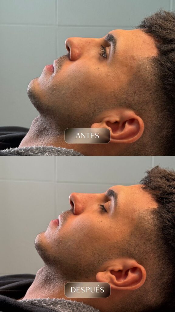 Antes y después - Rellenos - botox - bioestimuladores -13