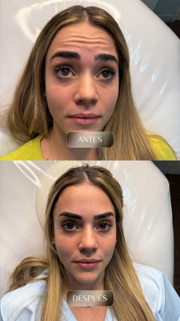 Antes y después - Rellenos - botox - bioestimuladores -5