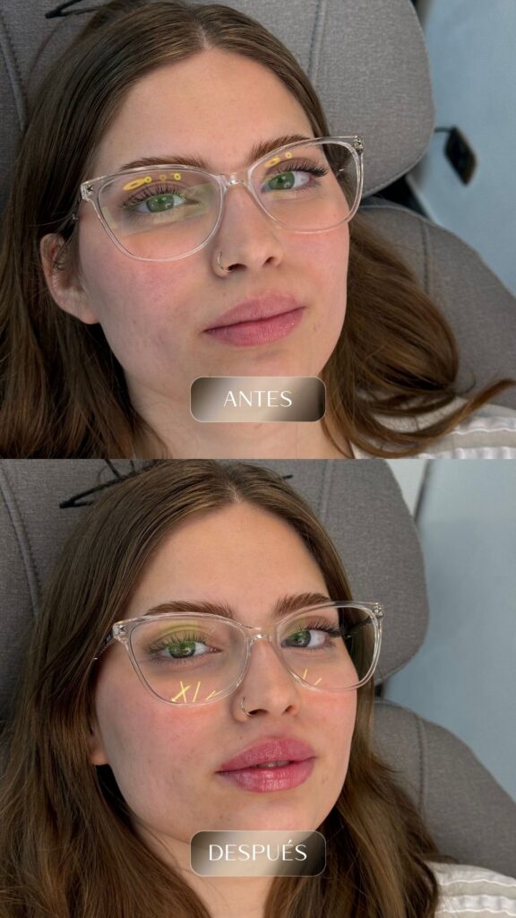 Antes y después - Rellenos - botox - bioestimuladores -4