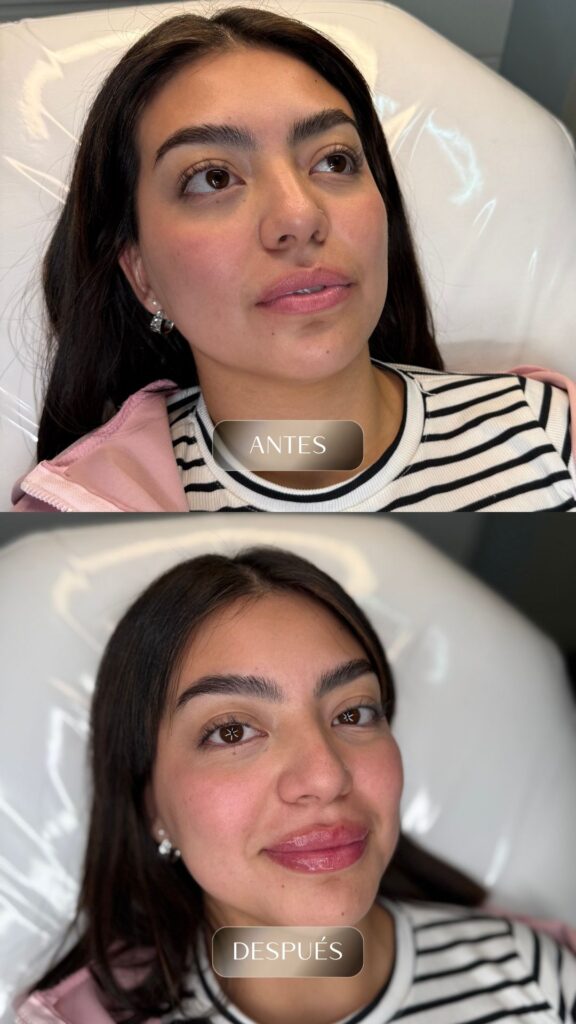 Antes y después - Rellenos - botox - bioestimuladores -3