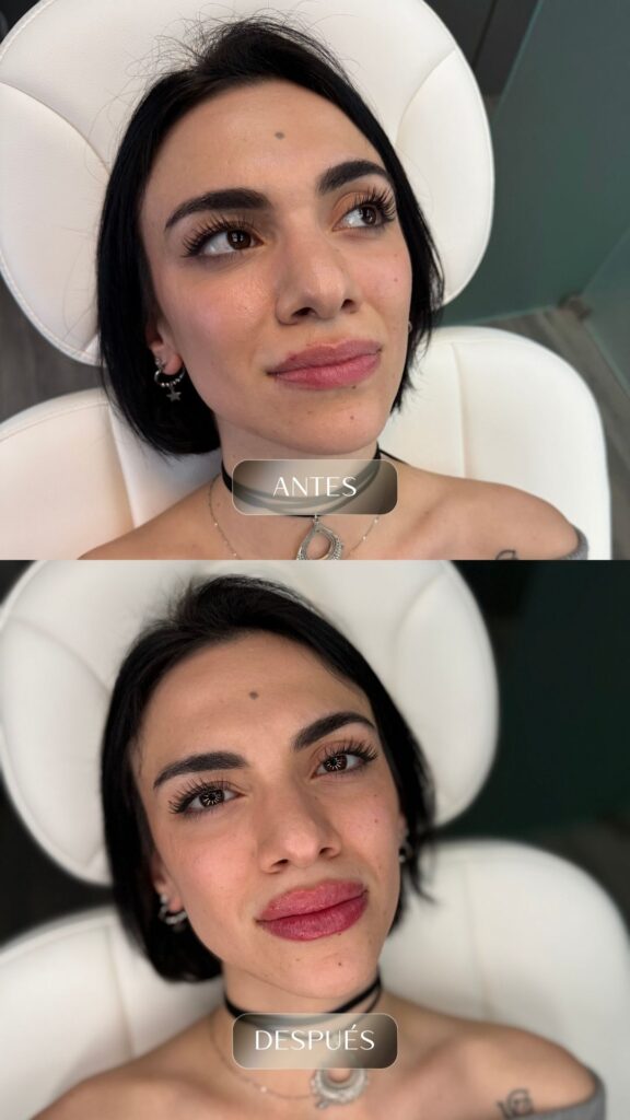 Antes y después - Rellenos - botox - bioestimuladores -2