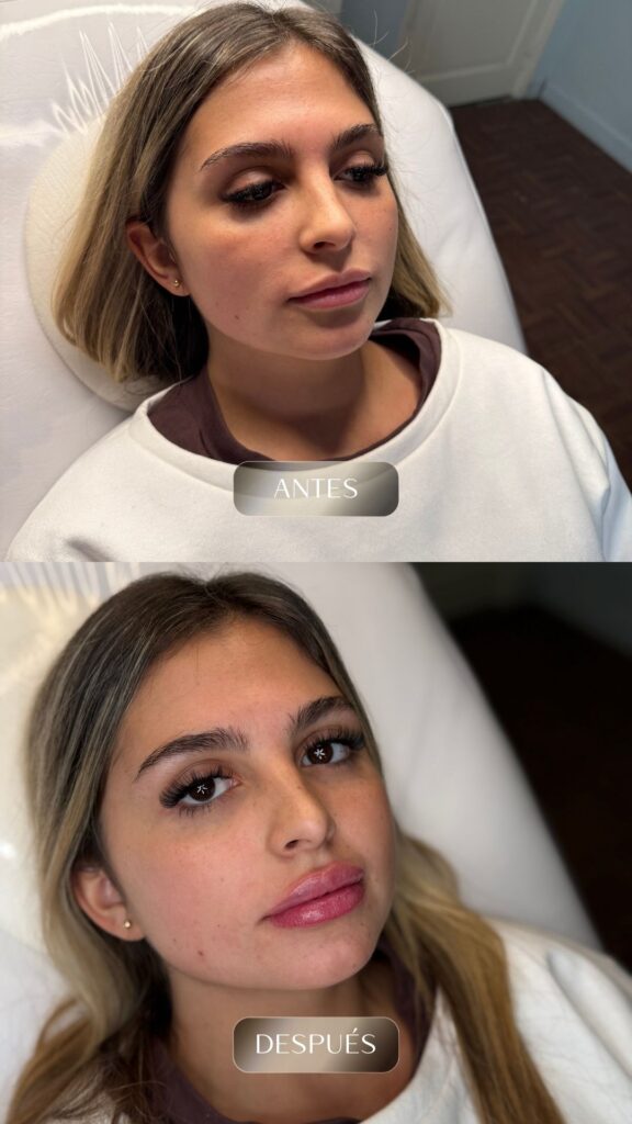 Antes y después - Rellenos - botox - bioestimuladores -1