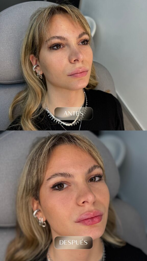Antes y después - Rellenos - botox - bioestimuladores -12