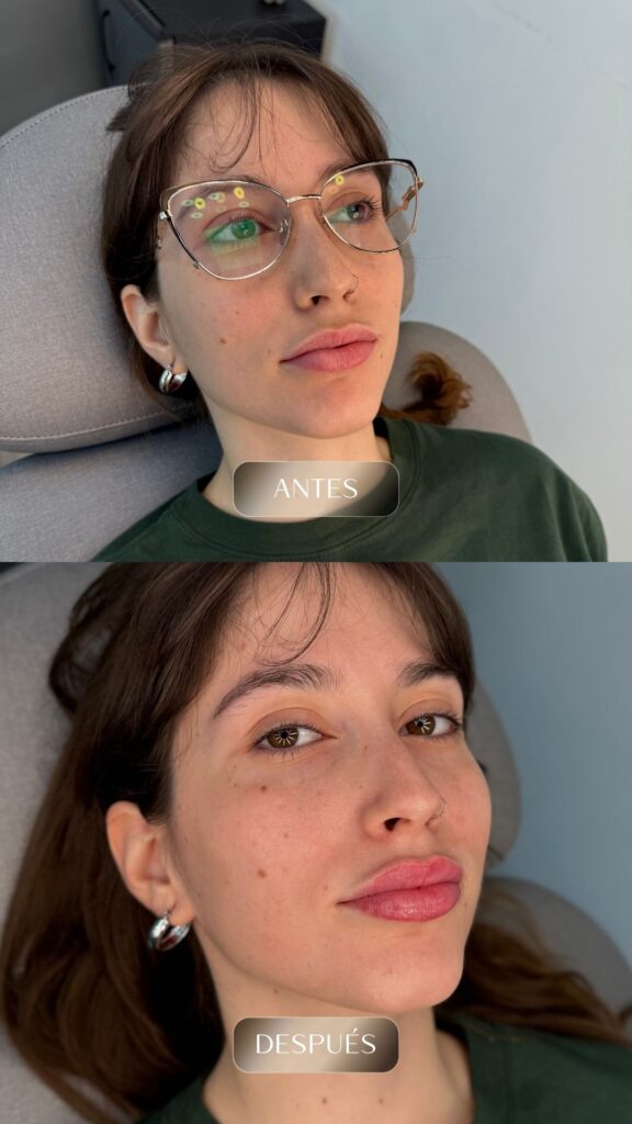 Antes y después - Rellenos - botox - bioestimuladores -11