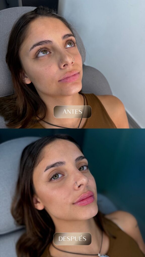 Antes y después - Rellenos - botox - bioestimuladores -10