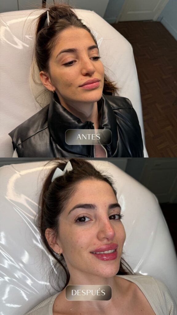 Antes y después - Rellenos - botox - bioestimuladores -9