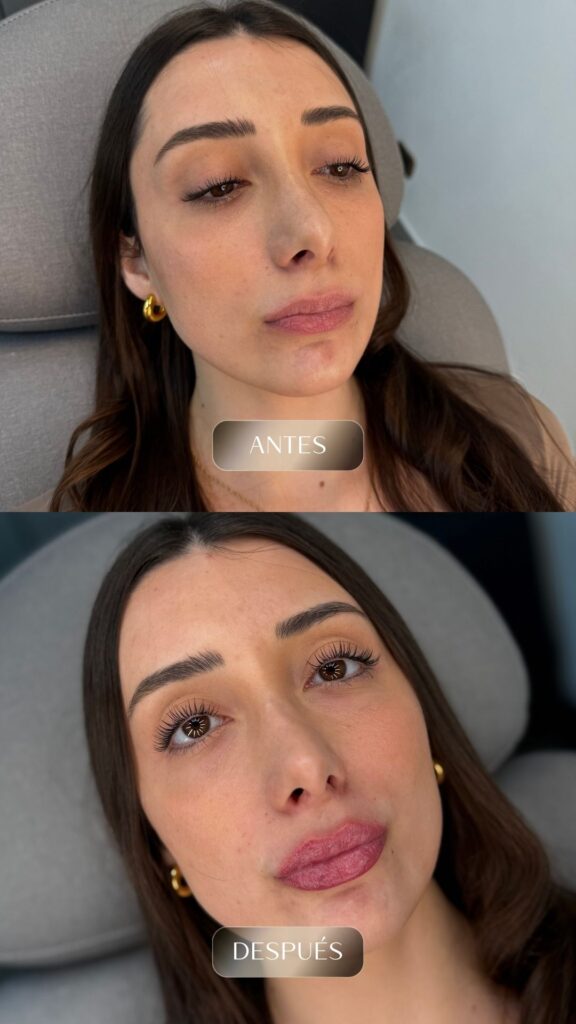 Antes y después - Rellenos - botox - bioestimuladores -8
