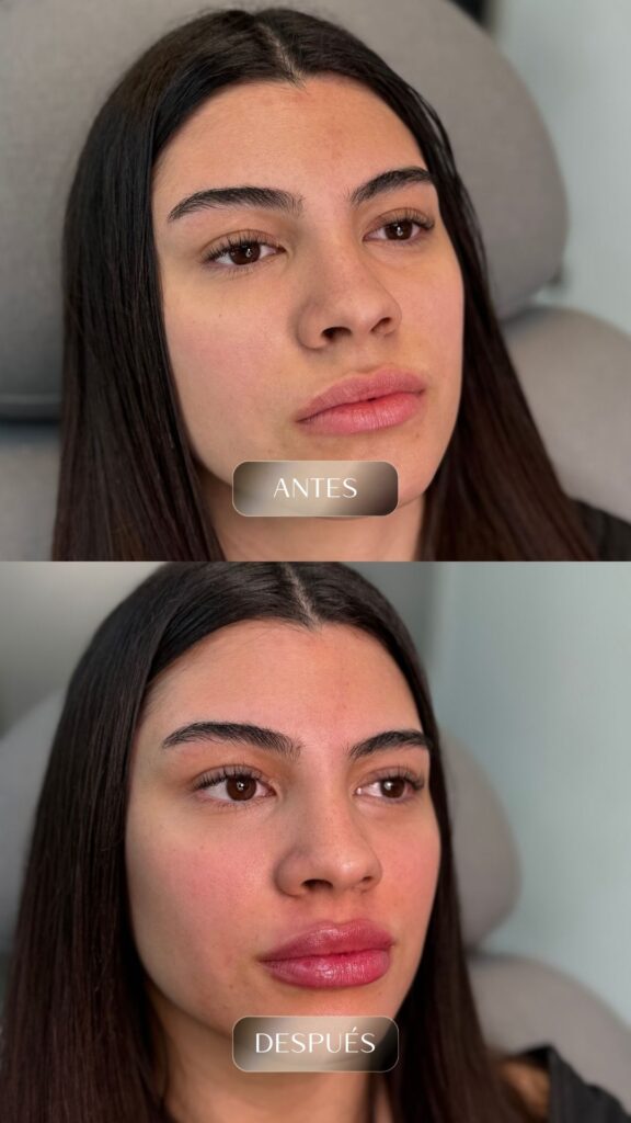 Antes y después - Rellenos - botox - bioestimuladores -7