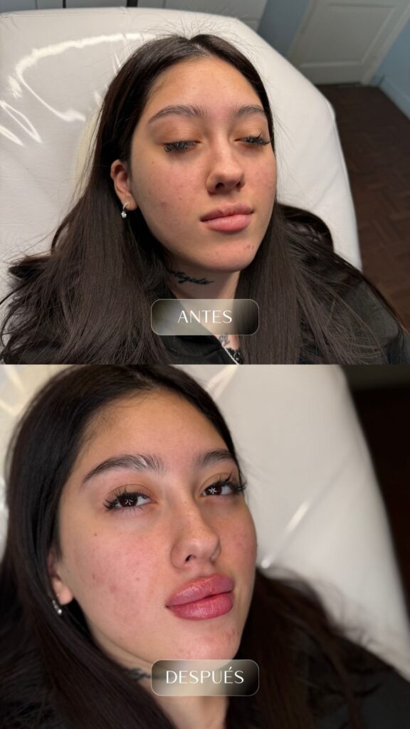 Antes y después - Rellenos - botox - bioestimuladores -6